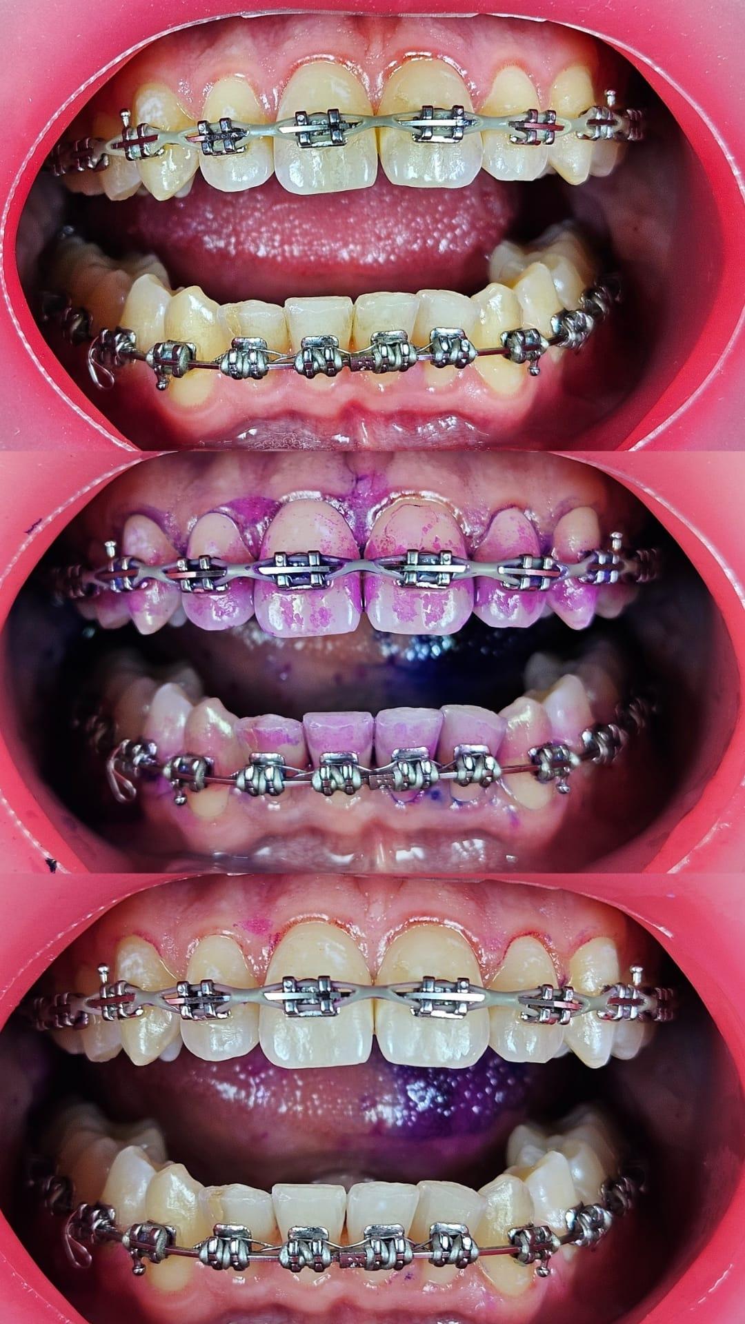 Lippen- und Wangenretraktion mit VisionButler